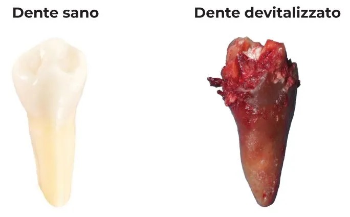 denti-devitalizzati