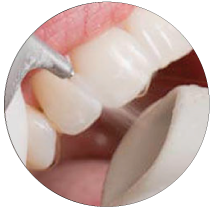 igiene-dentale-teeth-whitening